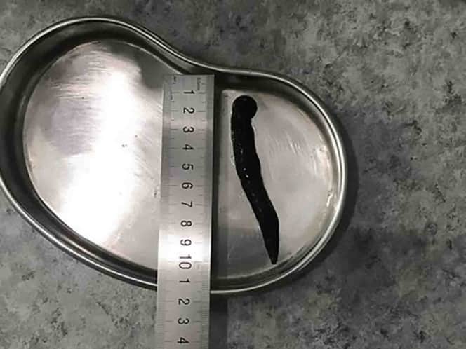 Tras toser sangre, hombre encuentra sanguijuela en su garganta