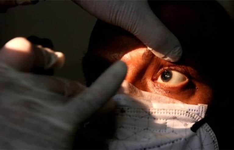 Confirman la primera víctima de muerte por “hongo negro” en Argentina