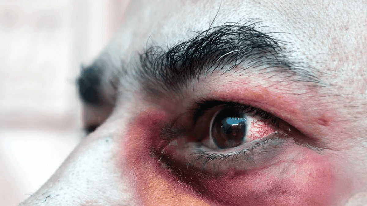 Niega IMSS que se haya diagnosticado caso de hongo negro en México