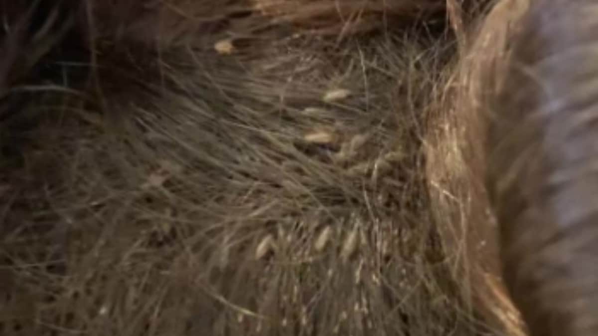 VIDEO: Revelan impactante caso de pediculosis en una niña, tardaron 9 horas en curarla