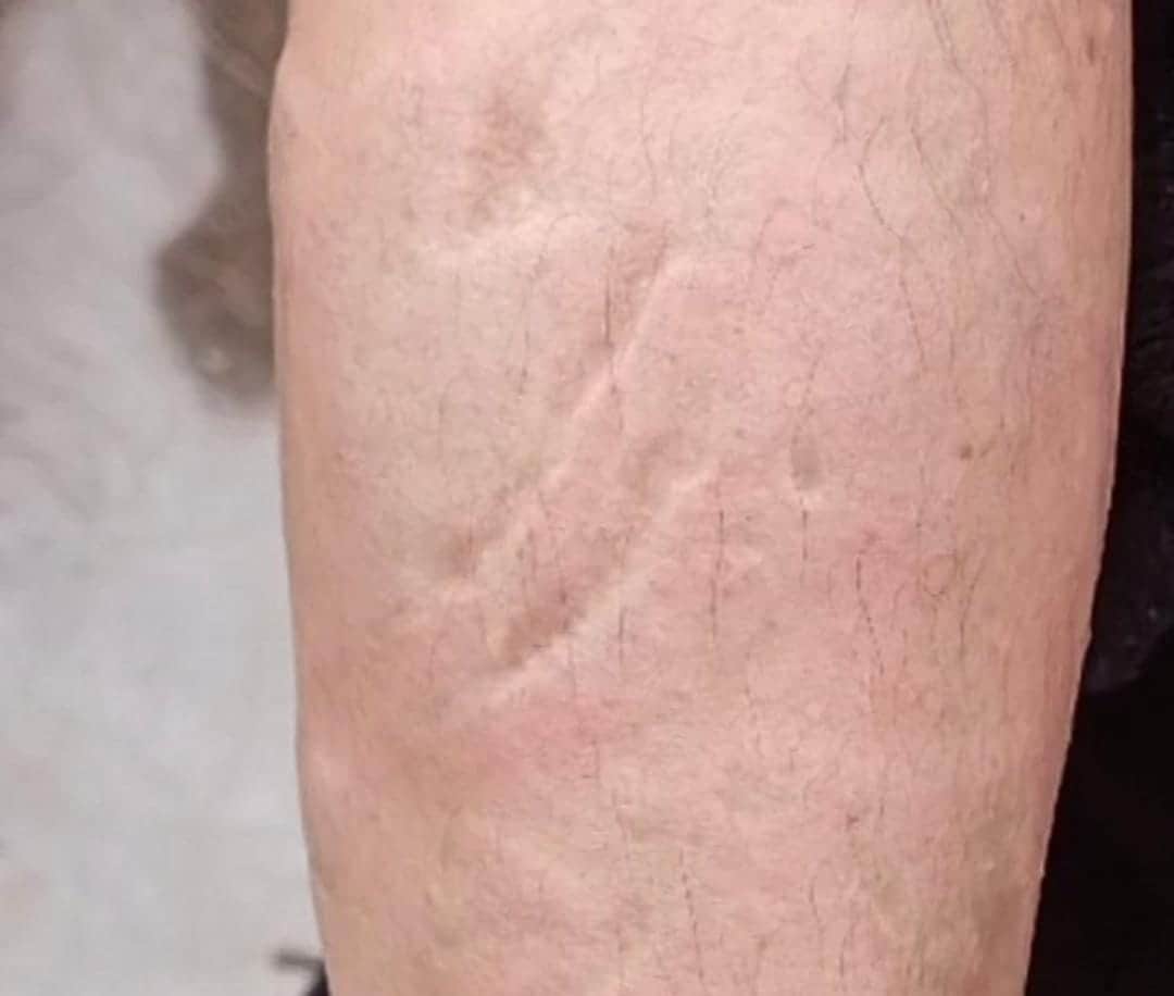 Alertan por ataque con ácido a una mujer en las calles de Puebla