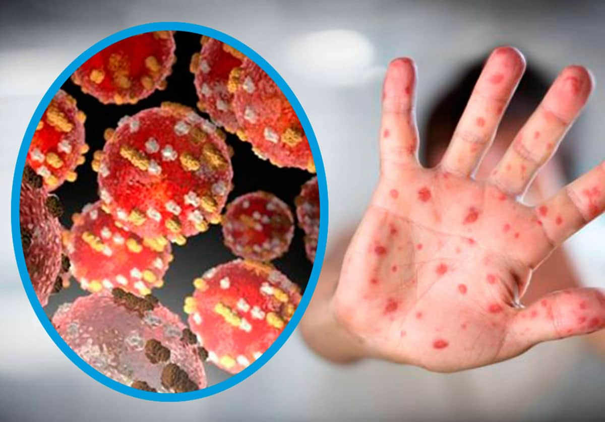 ÚLTIMO MOMENTO: La OMS declara la viruela del mono como emergencia sanitaria internacional