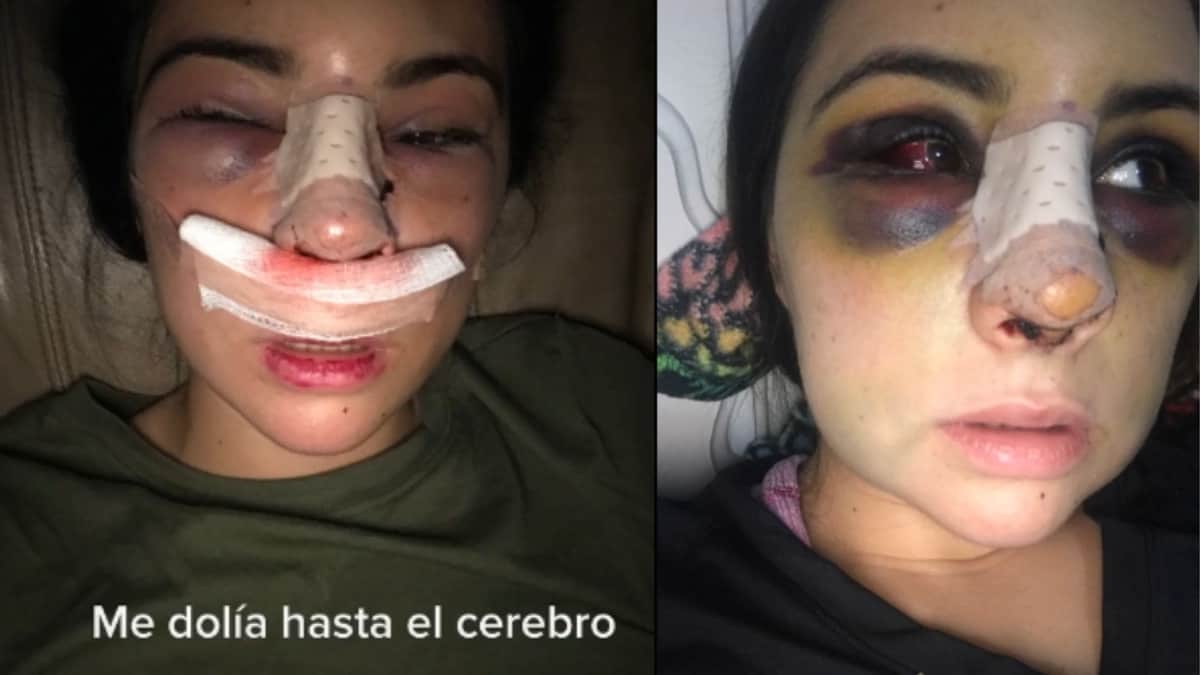 Video: Joven se hace viral tras mostrar su apariencia luego de una cirugía estética