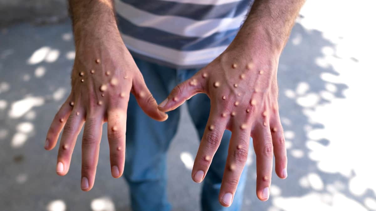 Es más letal y contagiosa viruela del mono; Quintana Roo, segundo estado con más casos