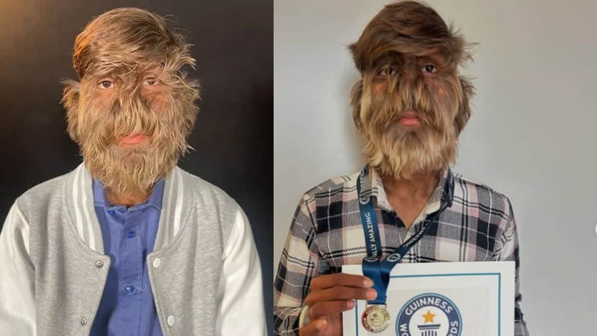 Joven originario de la India obtiene el Récord Guinness por tener el rostro más peludo del mundo