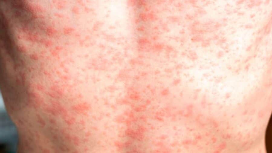 Organización Panamericana de la Salud emite alerta epidemiológica por brote de sarampión