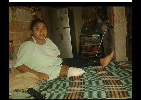 La atropellaron y le amputaron una pierna: Vendedora de fruta pide justicia