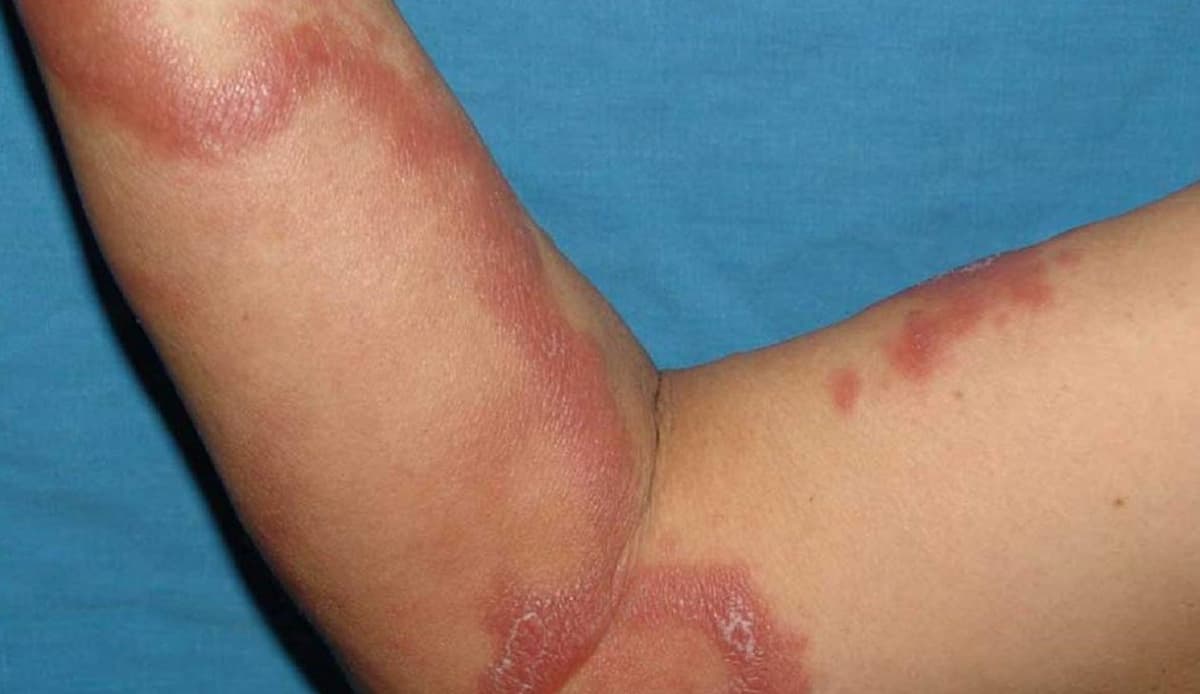 No hay alerta en Quintana Roo por casos de lepra: Secretaría de Salud