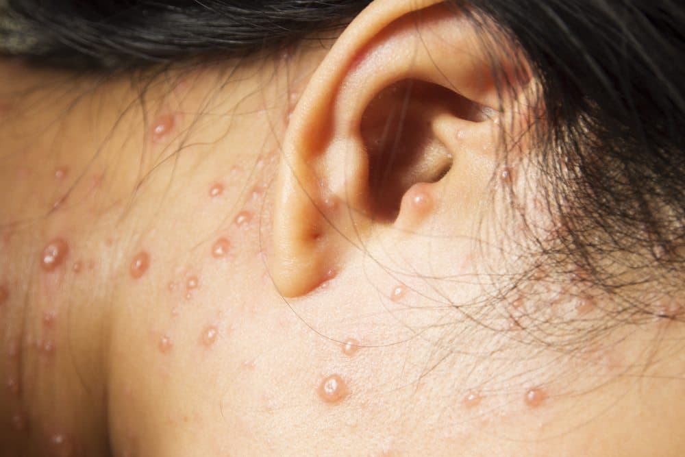 Molusco contagioso, infección dermatológica frecuente en vacaciones