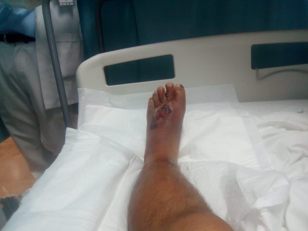 Perderá el pie por negligencia del IMSS en Cancún