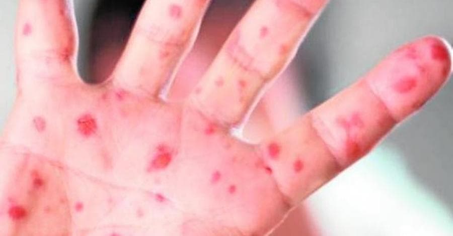 Otro caso de sarampión en Playa del Carmen, sería el quinto