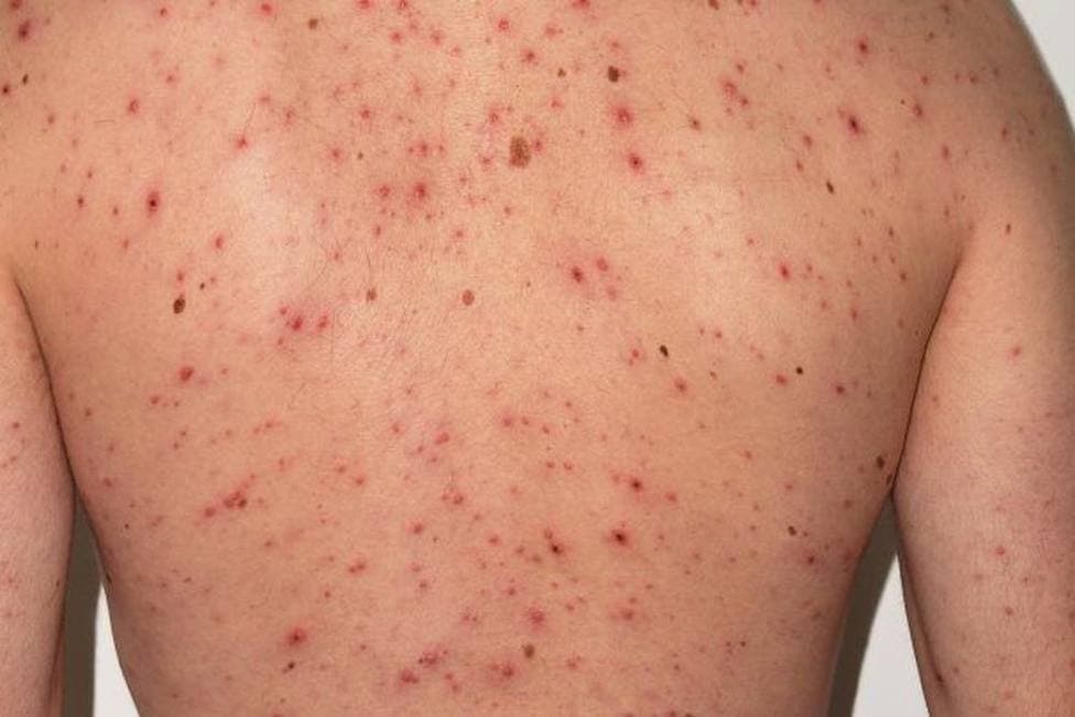 Detectan a turista con sarampión en la Riviera Maya; lo aíslan a tiempo