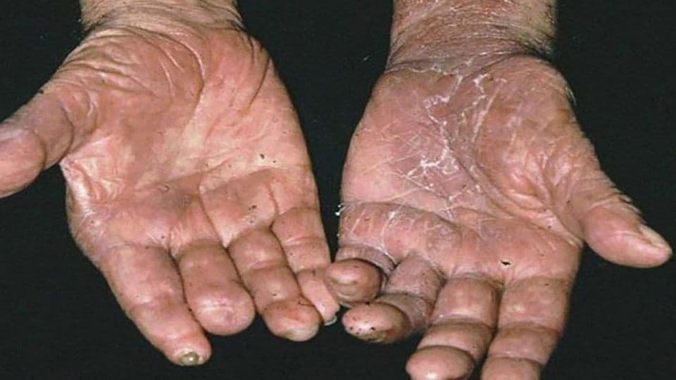 Detectan 10 casos de lepra en Quintana Roo