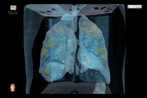 Video: Difunden imágenes de pulmones dañados por Covid-19