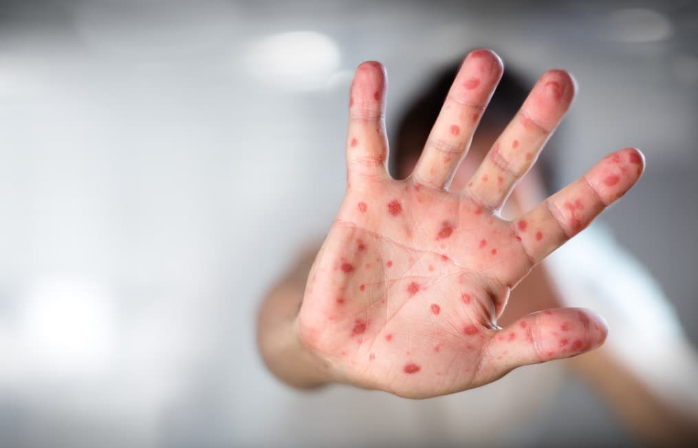 Confirman ya 26 casos de sarampión en México; más contagioso y letal que Covid-19