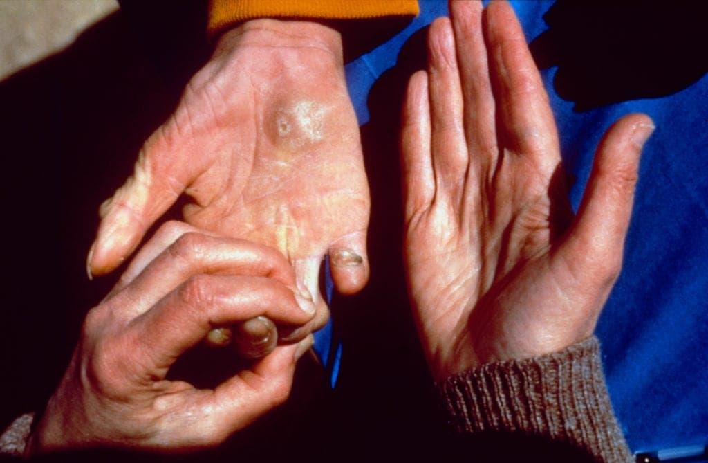 18 estados mexicanos reportan casos de lepra