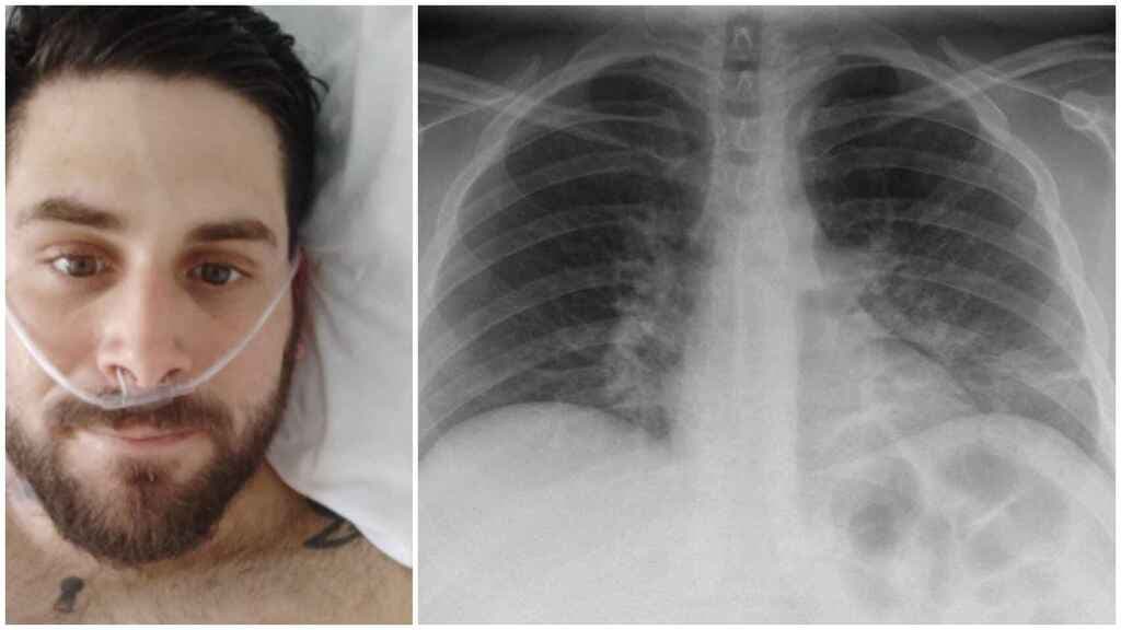 Conoce los talleres de la UNAM para rehabilitar los pulmones de pacientes que tuvieron Covid-19