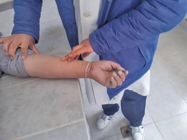 Mujer se amputa la mano para cobrar millonario seguro, pero no recibió ni un peso