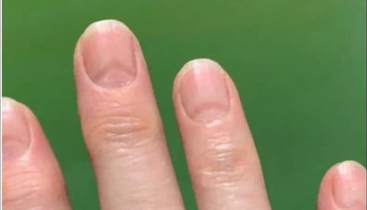 Covid-19 dejaría marcas en las uñas incluso semanas después de contagiarse