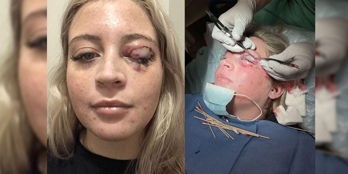 ¡Casi pierde el ojo! Perro chihuahua le arranca el párpado a joven