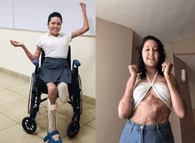 TikTok: Así vive una joven con el 90% del cuerpo quemado y una amputación