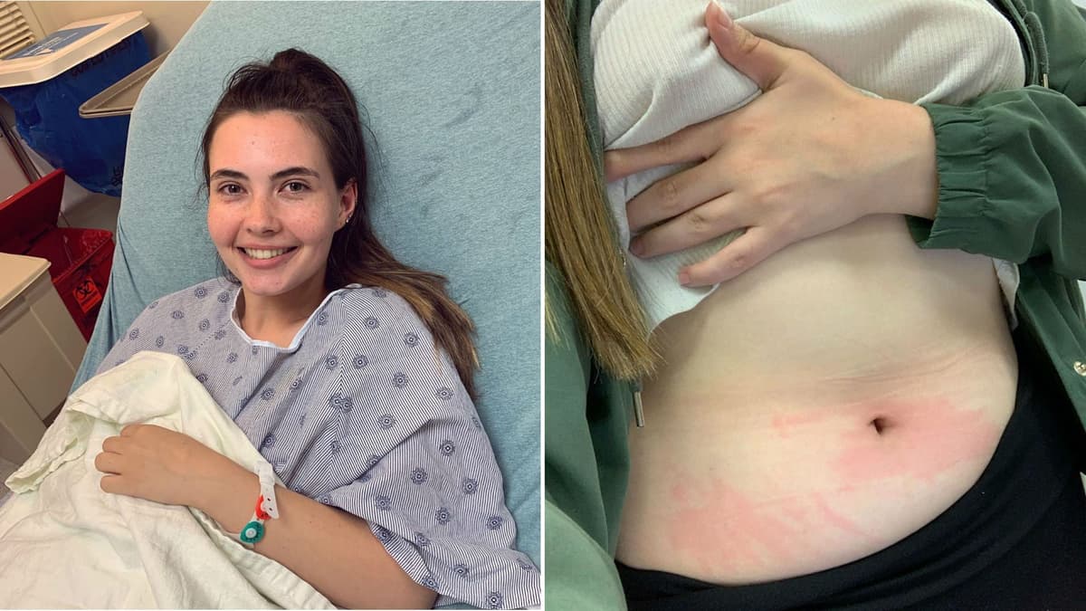 ¡Impresionante! Una joven solo puede bañarse 2 veces al mes por ser alérgica al agua