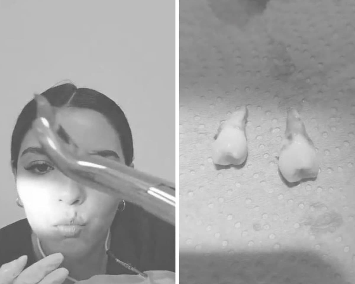 VIDEO: Mujer se quita la muelas del juicio con unas pinzas y sin asistencia