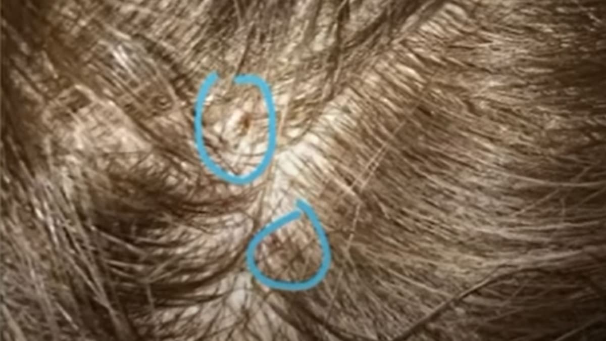 VIDEO: Madre acusa a profesora de agredir a su hija de 5 años con un lápiz en la cabeza