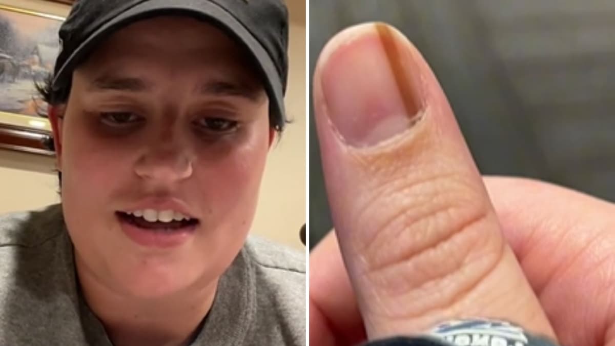 Video: Tiktoker tenía una mancha en la uña que le 'parecía cool' por 10 años, era un cáncer