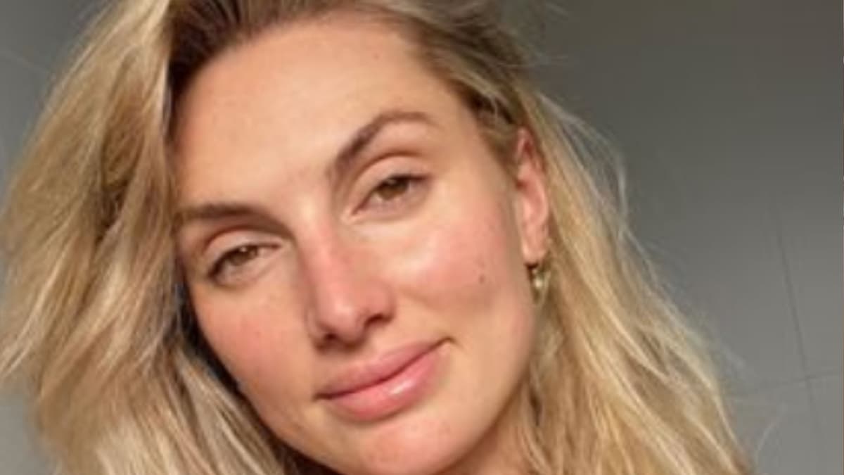 Modelo creyó que le salió una peca en la pierna, se trataba de algo más grave