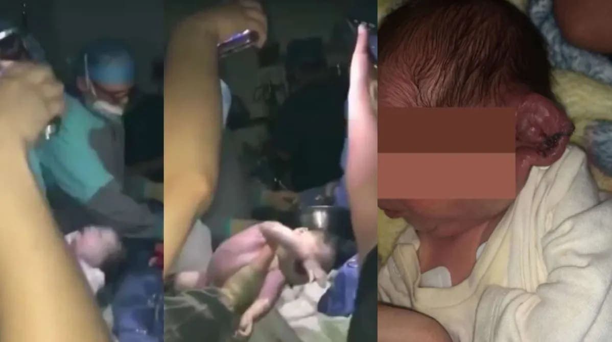 Doctores realizan cesárea con la luz de tres celulares y cortan accidentalmente oreja del bebé