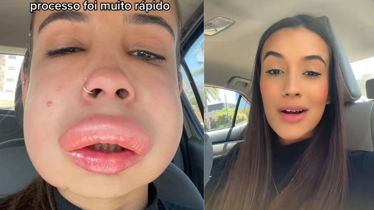 VIDEO: Mujer termina con terrible reacción alérgica tras inyectarse los labios