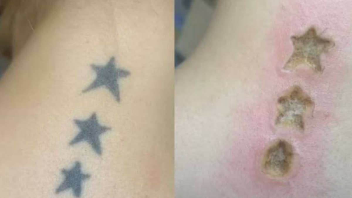 Denuncian clínica por "quemar" la piel al remover tatuajes