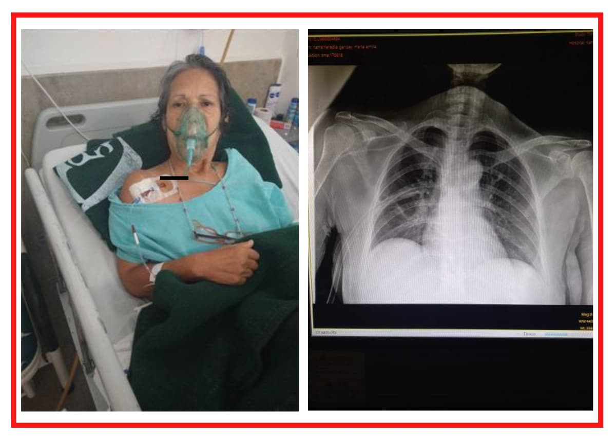 Denuncian NEGLIGENCIA en el IMSS: Fue a que le quitaran la vesícula y le perforaron el pulmón