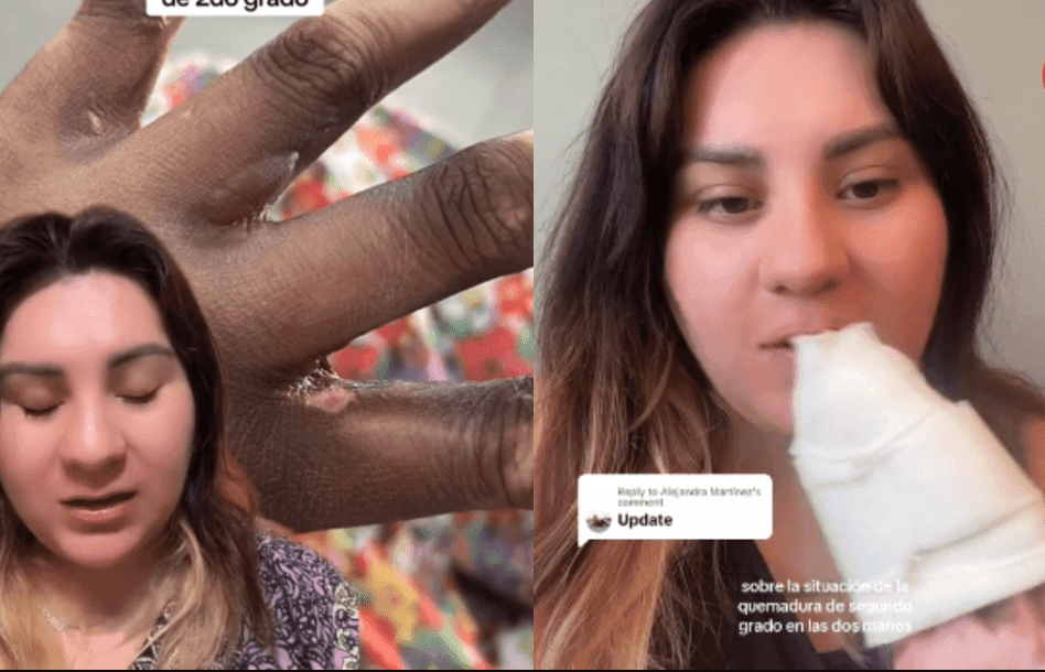 VIDEO: Mujer que afirma haber sido funcionaria de casilla acusa que sufrió quemadura por tinta indeleble