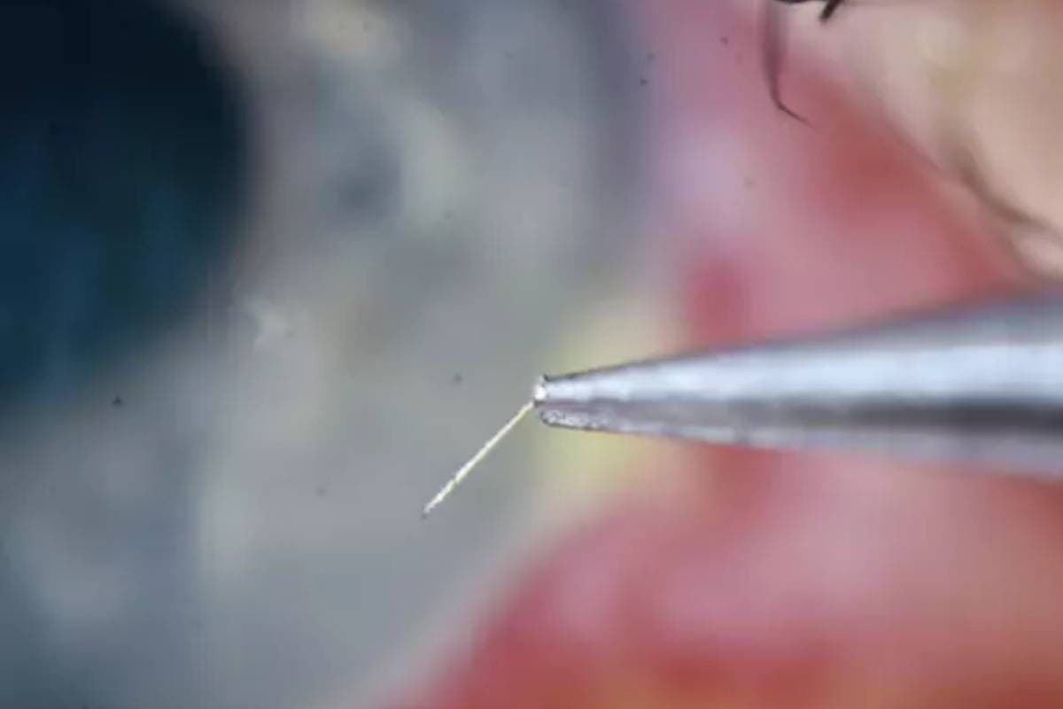 Una abeja lo picó en el ojo y la víctima casi quedó ciega por el aguijón incrustado