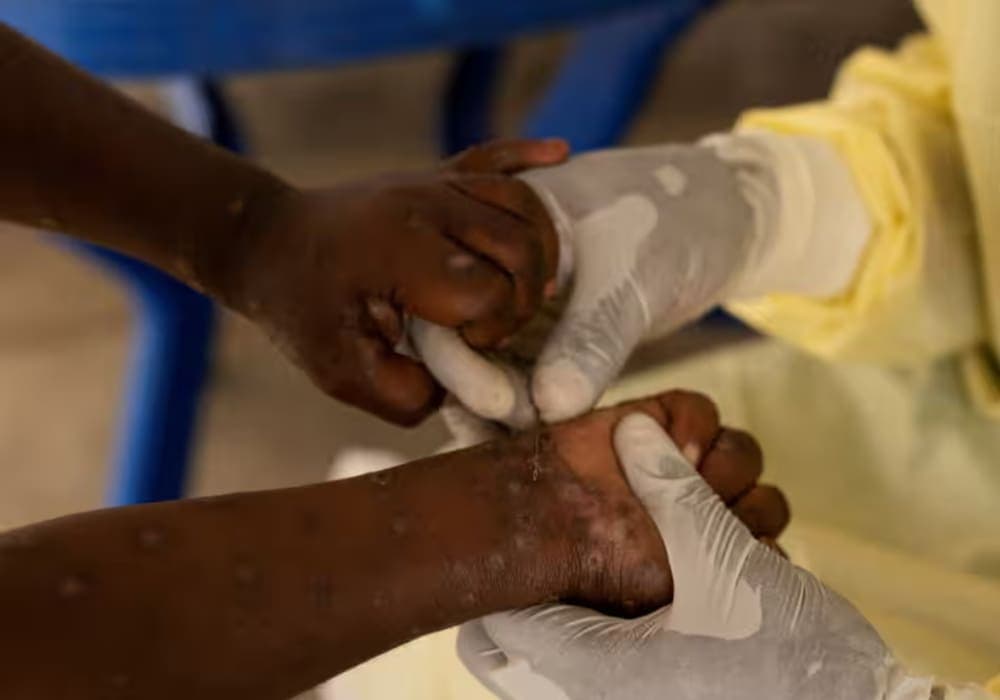 OMS declara nuevamente a la viruela del mono como emergencia internacional