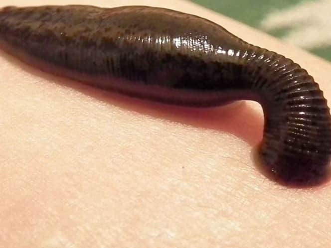 Encuentran sanguijuela viva en garganta de un niño