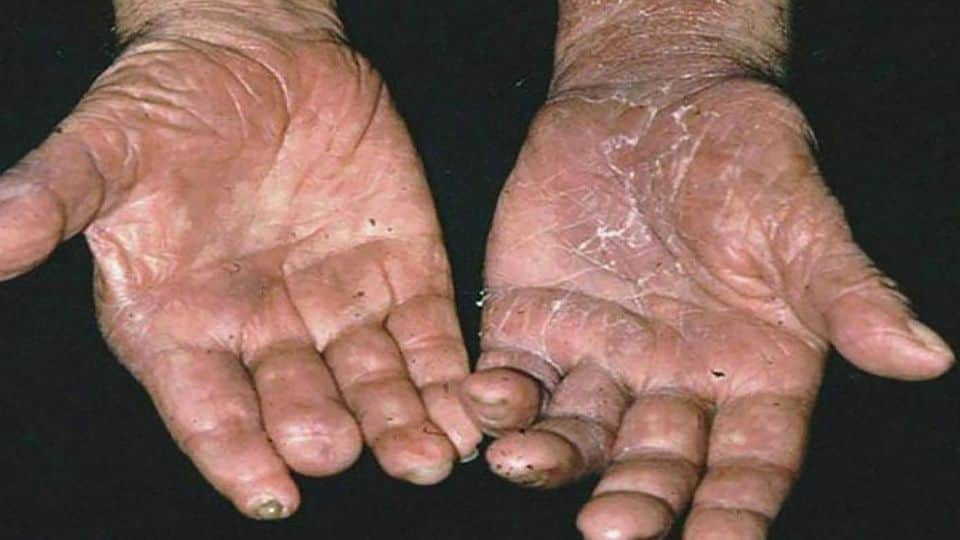 Detectan 10 casos de lepra en Quintana Roo