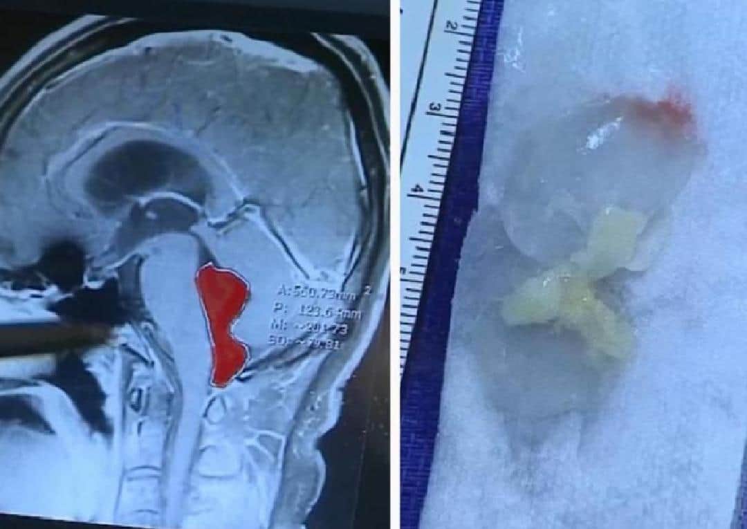 Video: Creía que era un dolor de cabeza; ¡tenía un gusano en el cerebro!