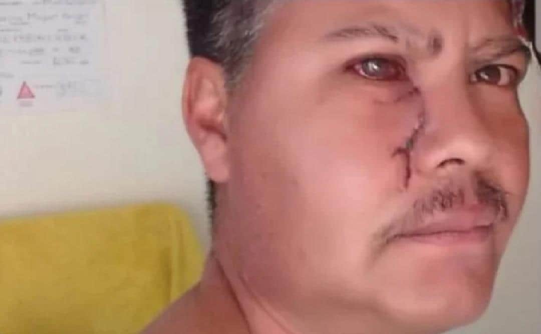 Árbitro perderá un ojo tras ser agredido por futbolista expulsado