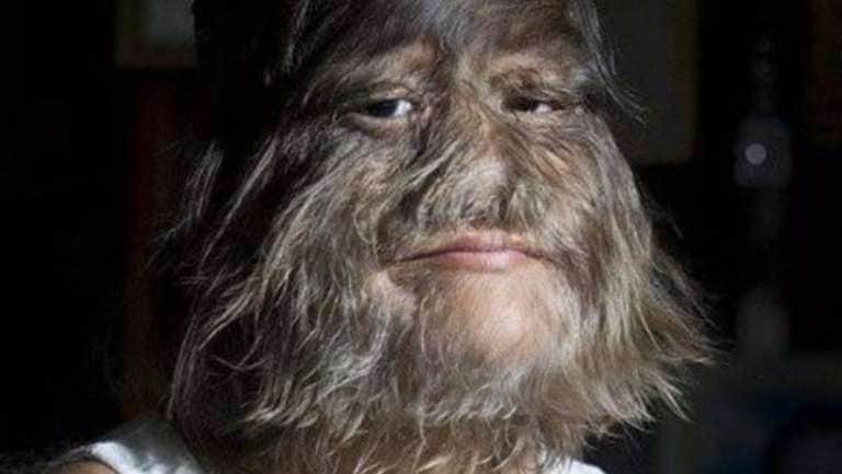 Así luce la 'niña más peluda del mundo' afeitada; está enamorada