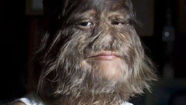 Así luce la 'niña más peluda del mundo' afeitada; está enamorada