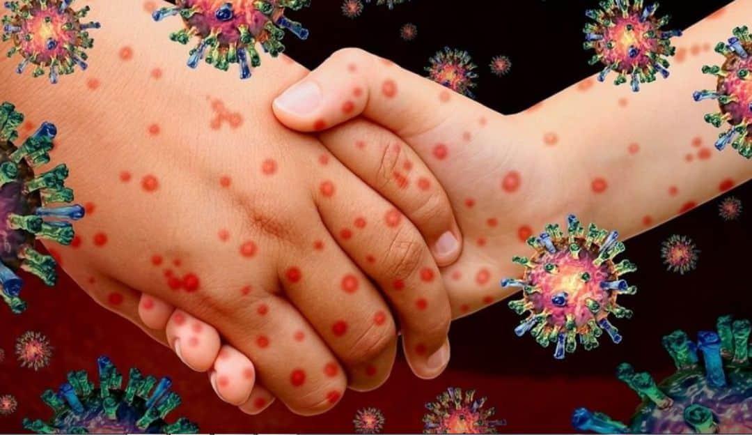 Aumentan contagios de sarampión en México; ya se han confirmado 10 casos