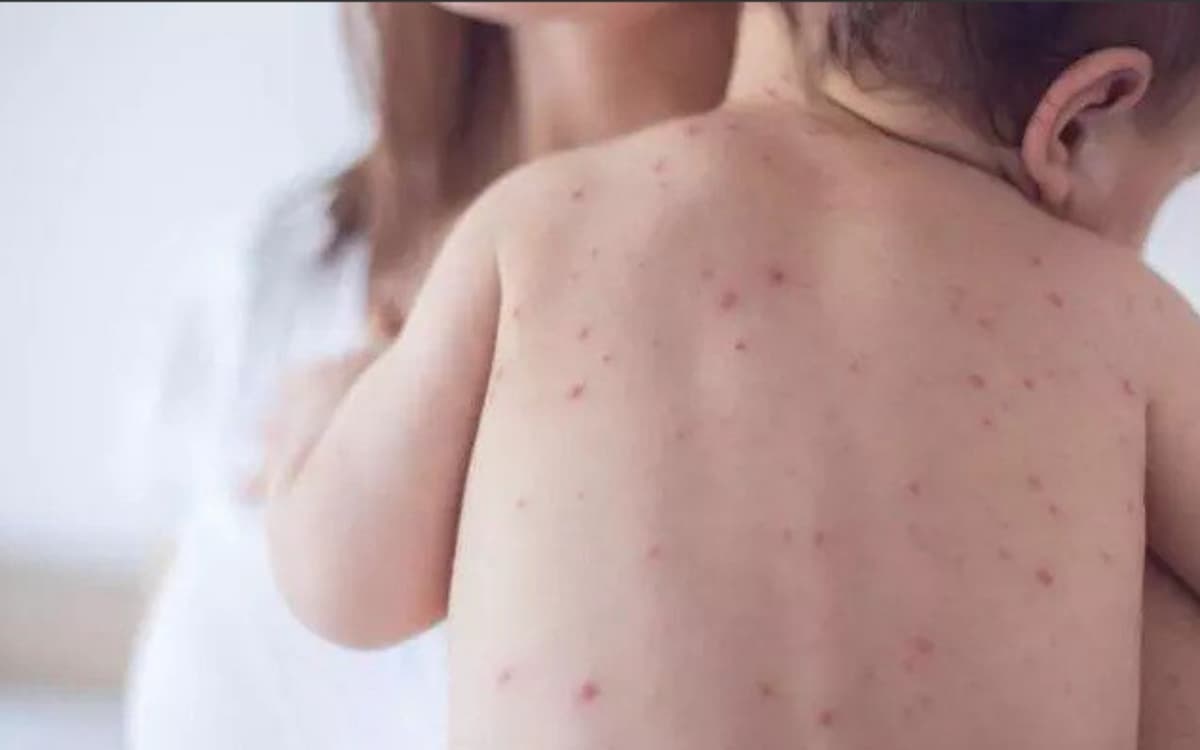 Suman ya 87 casos positivos de sarampión en México