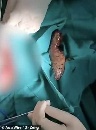 Operan a hombre para sacarle un pez en el que "se sentó por accidente"