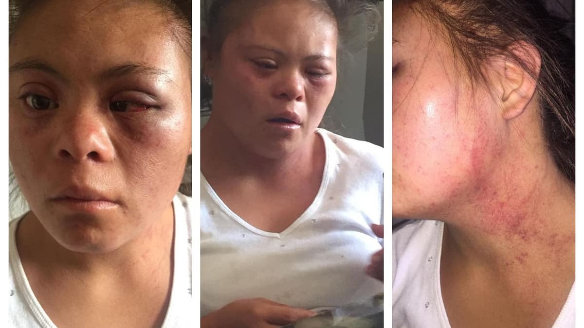 Con total brutalidad, padre golpea a su hija con Síndrome de Down
