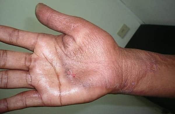 Detectan tercer caso de lepra en Quintana Roo