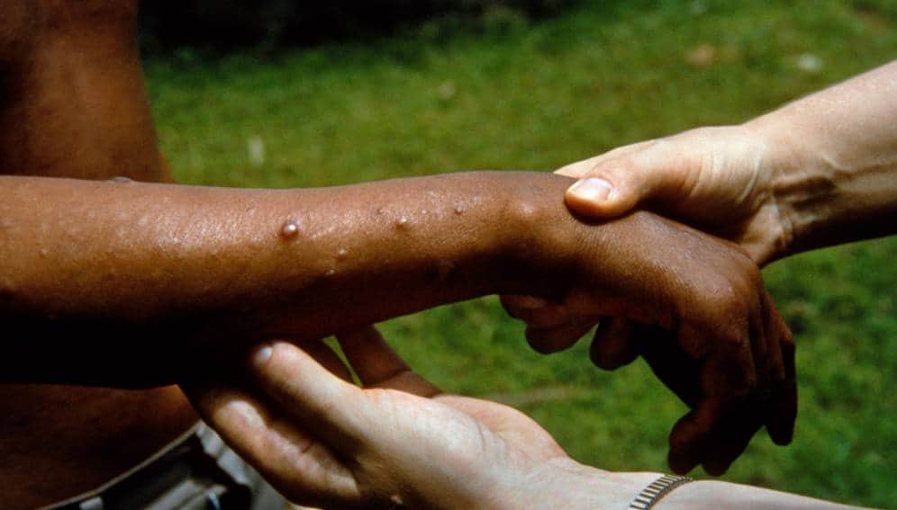 Se registran en Quintana Roo los dos primeros casos de lepra