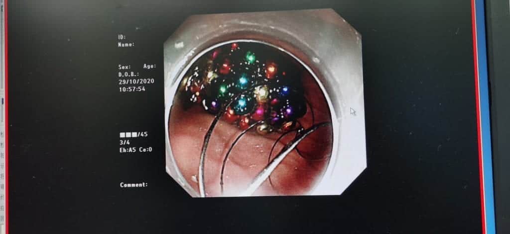 Niño dice comerse sólo 1 bolita magnética mientras veía TV pero ¡le extraen más de 100!